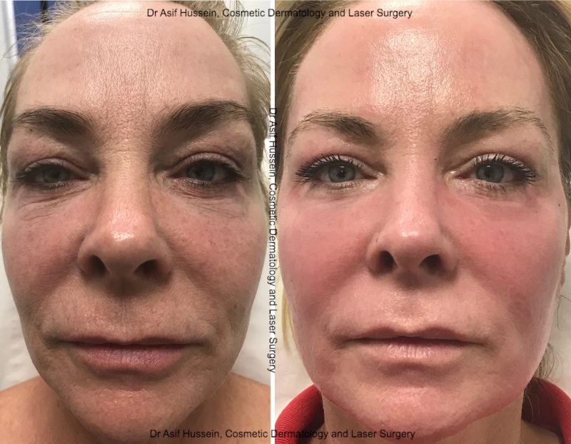 Ablative CO2 Photos Dr. H Consult