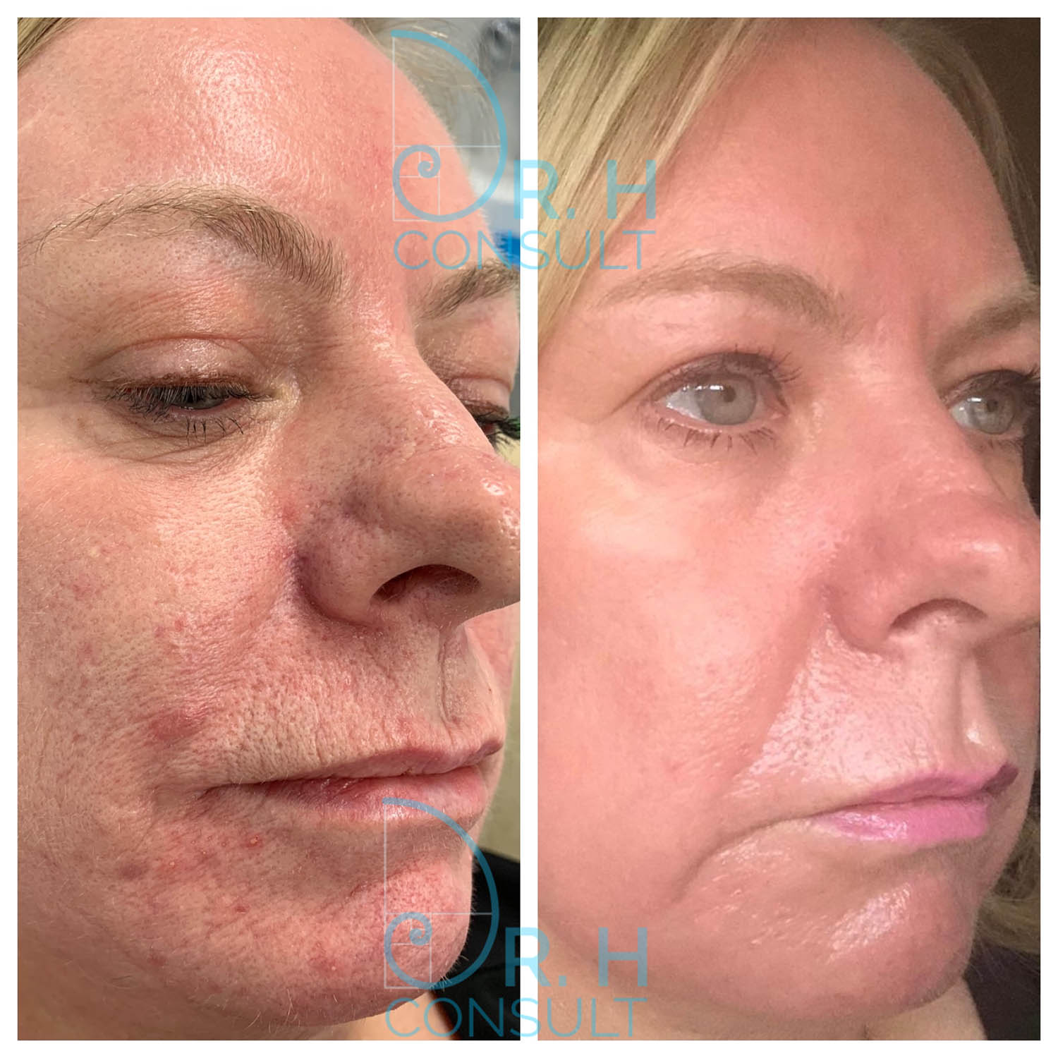 Fully Ablative Laser Resurfacing