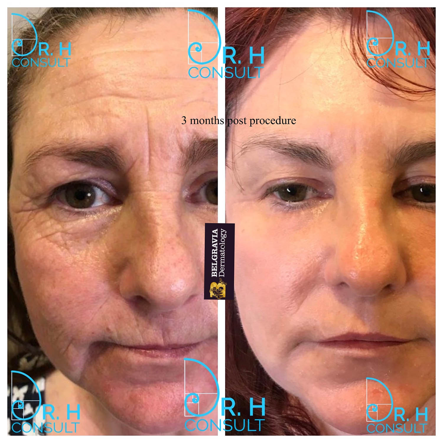 CO2 Fractional Laser Skin Resurfacing Before & After (Updated 2023