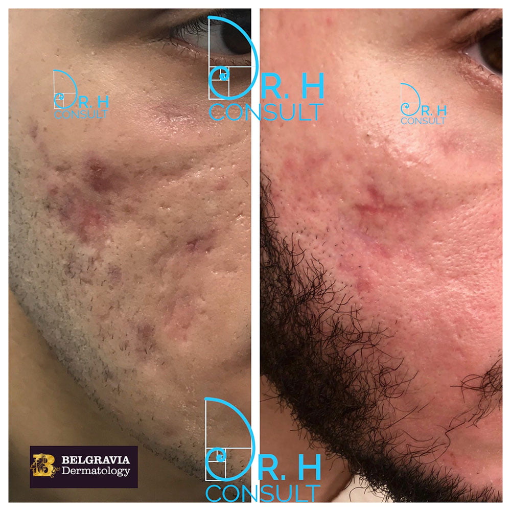 Acne Scar Laser Treatment & Removal London | Dr H Consult