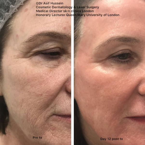 This lady has also been treated with a fully ablative CO2 resurfacing procedure by Dr Hussein. The rejuvenation capability of this treatment is outstanding. The photos make this immediately obvious. Look carefully at the eye area. Dr Hussein included eyelids in this treatment as well. Look at the degree of tightening and wrinkle reduction around the eyes.