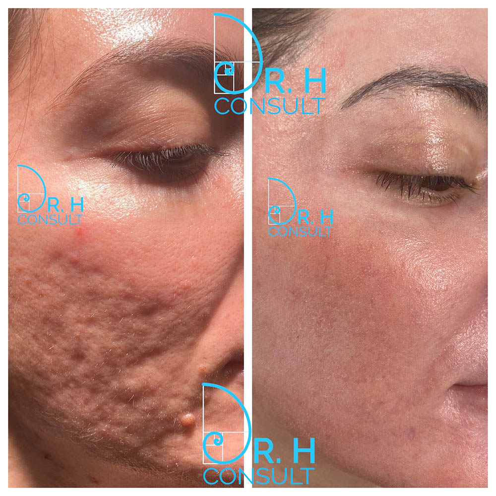 Acne Scar Laser Treatment & Removal London | Dr H Consult