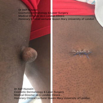This photo shows the before and after following removal of a benign tumor that I performed on this gentleman’s leg.