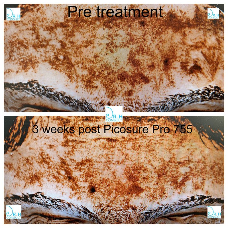 Melasma before and after image