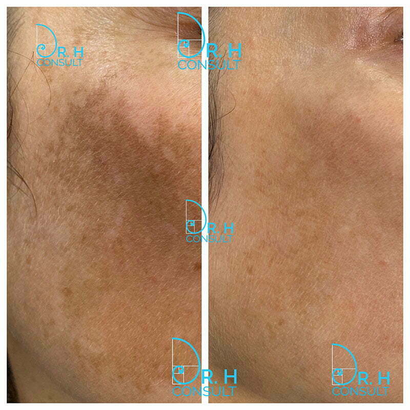 Dr H - Melasma before and after