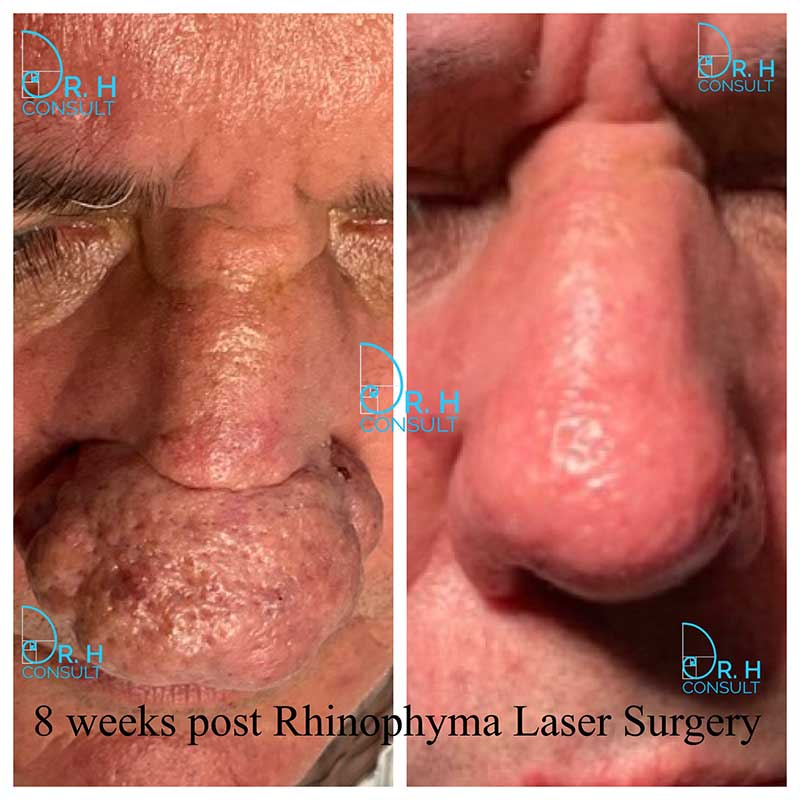 rhinophyma before after 001