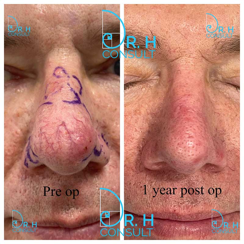 rhinophyma before after 004