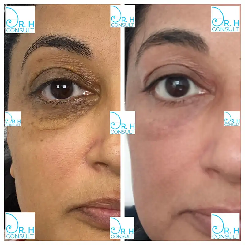 xanthelasma-before-after-01