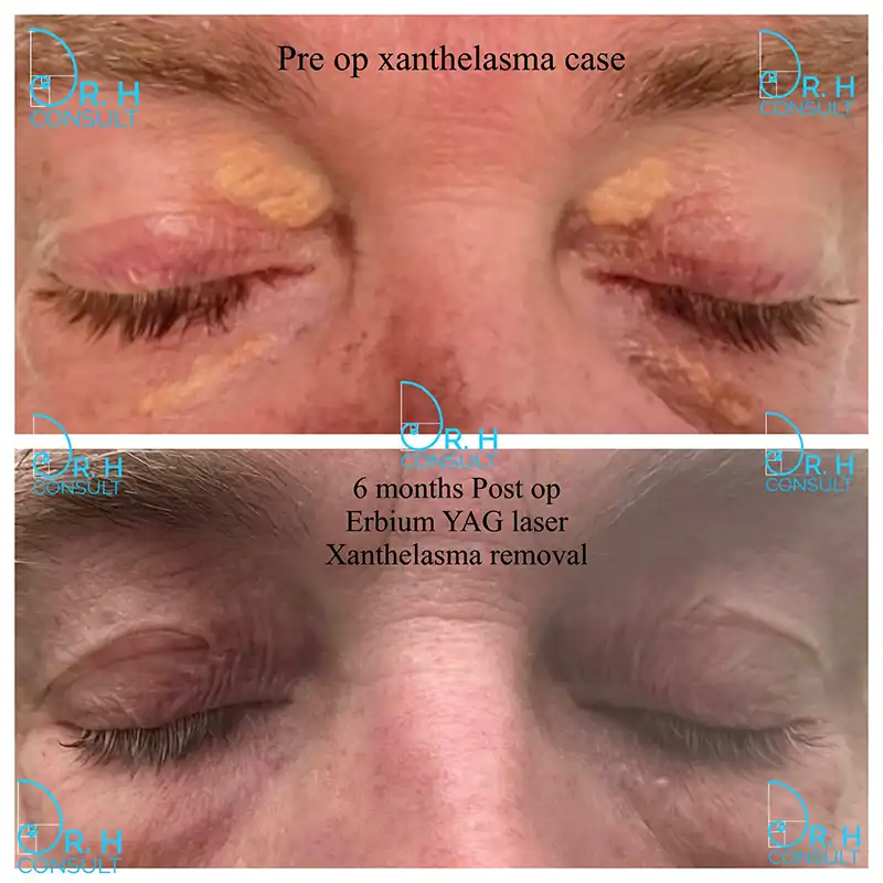 xanthelasma-before-after-03