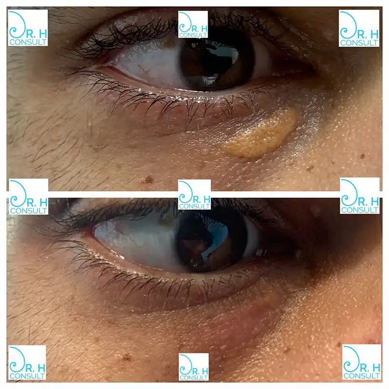 xanthelasma-before-after-05