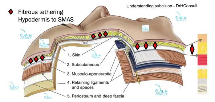 Diagram of fibrous tethering hypodermis to SMAS