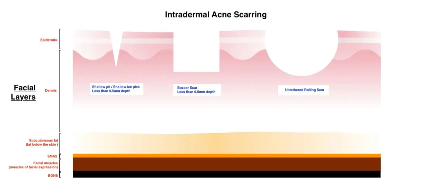 intradermal acne scarring
