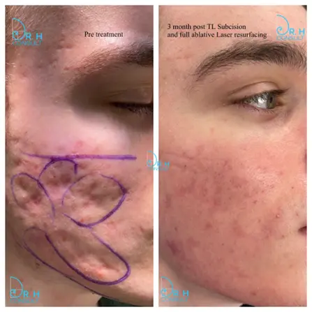 Tethered acne scarring example 1