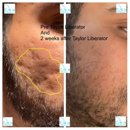 Tethered acne scarring example 2