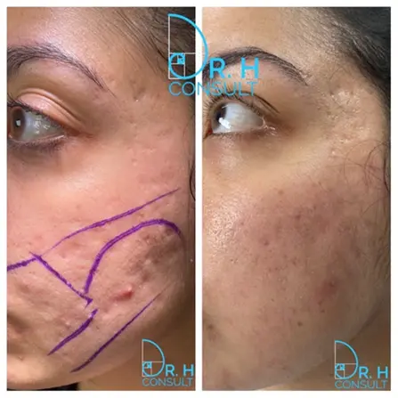 Tethered acne scarring example 3