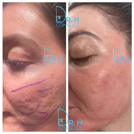 Tethered acne scarring example 4