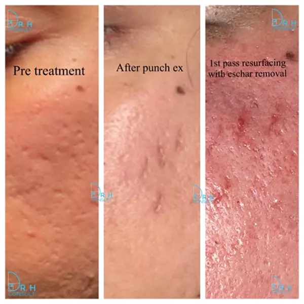 punch excision before after