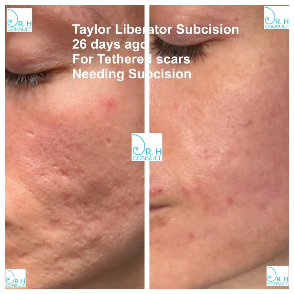 taylor liberator subcision 26 day post
