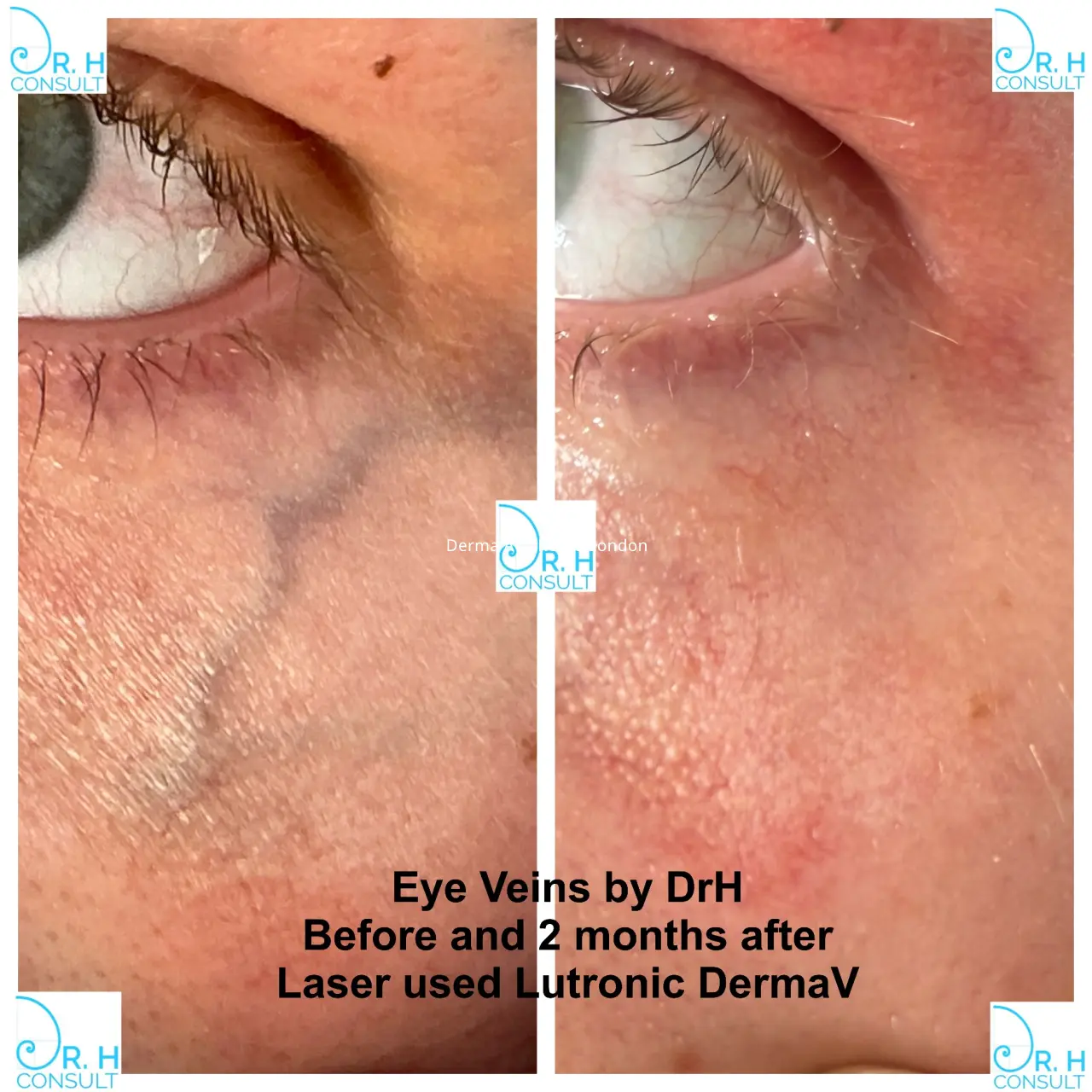 eye vein gallery 01
