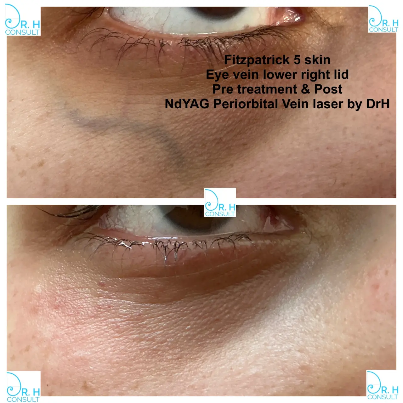 eye vein gallery 02