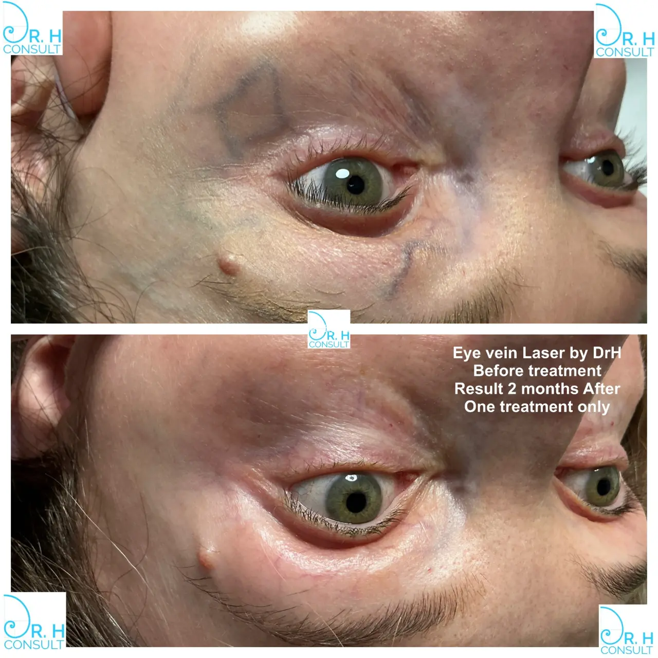 eye vein gallery 04
