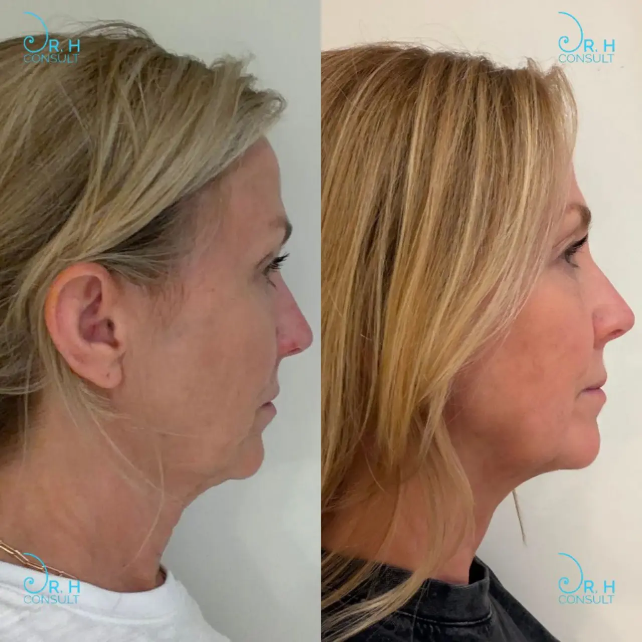 ignite quantum rf assisted lipolysis 02