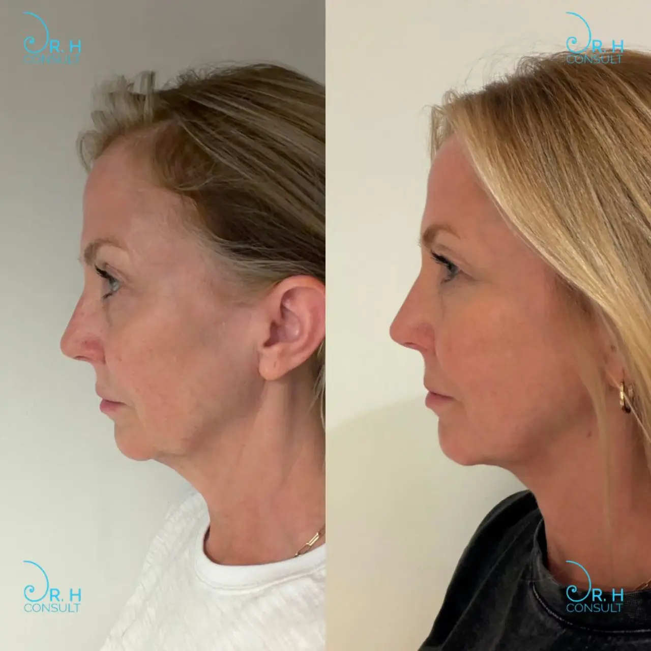 ignite quantum rf assisted lipolysis 03